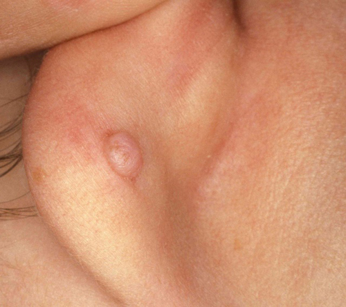 Sẹo lồi bị gây ra sau khi bấm lỗ tai 
