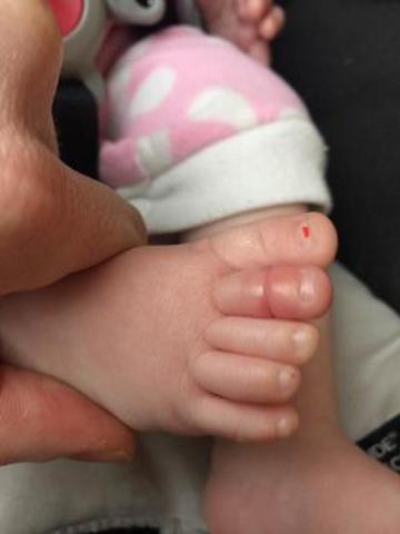 Ngón chân áp cái của trẻ sau khi khi bị sợi tóc quấn chặt đã có dấu hiệu sưng đỏ (Facebook: Scott Walker)