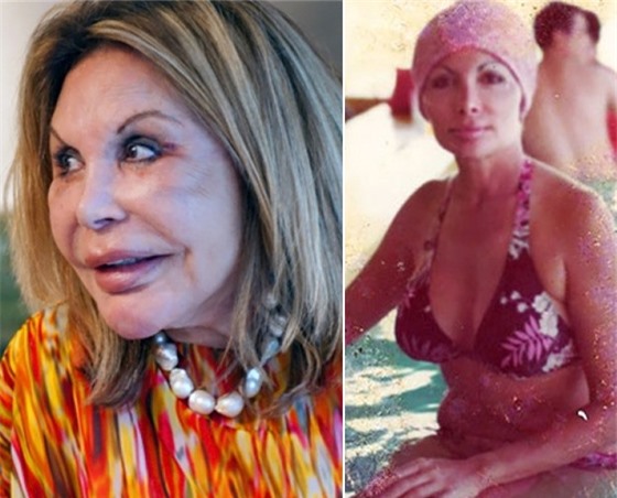 Sau nhiều năm dao kéo, ngôi sao của show truyền hình Real Housewives Of Miami, Mama Elsa Patton đã có nhan sắc xuống dốc không phanh