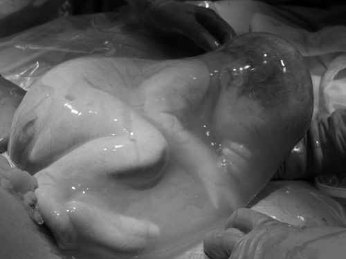 Một em bé nằm trọn trong bọc ối khi nước ối còn chưa bị vỡ.  