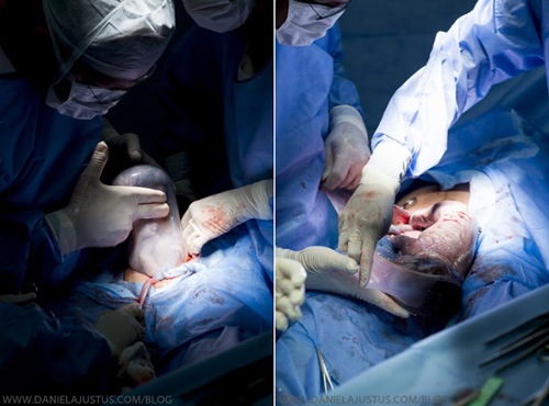 Hình ảnh trong ca sinh mổ 3 em bé nhưng bất ngờ em bé thứ 2 nằm nguyên trong bọc ối. 