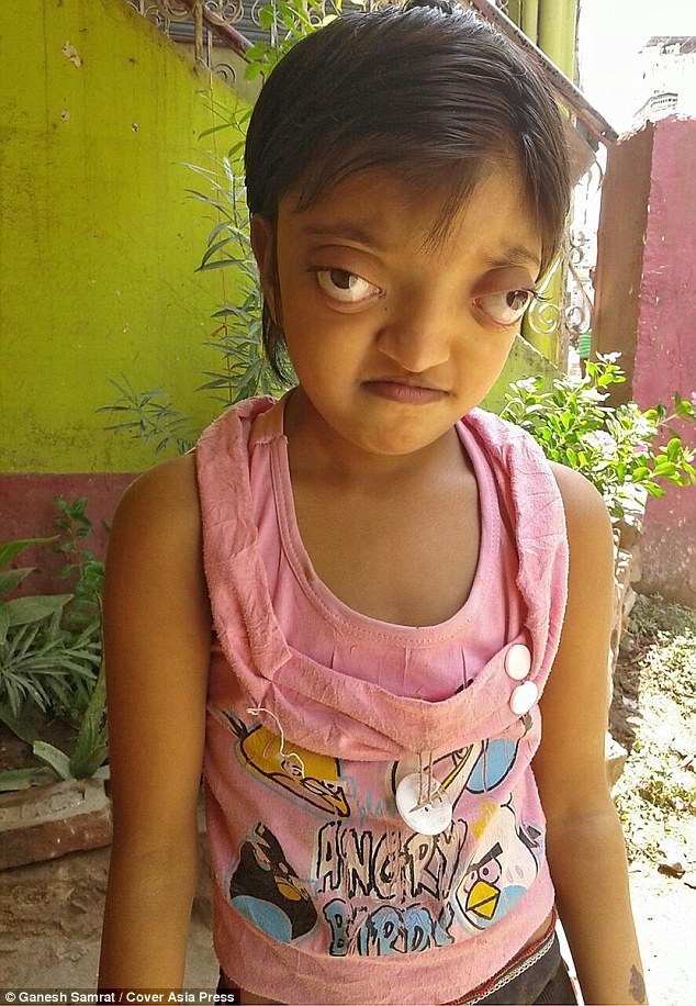 Shaili Kumari có đôi 'mắt ếch' khiến nhiều người tránh xa rất tội nghiệp.