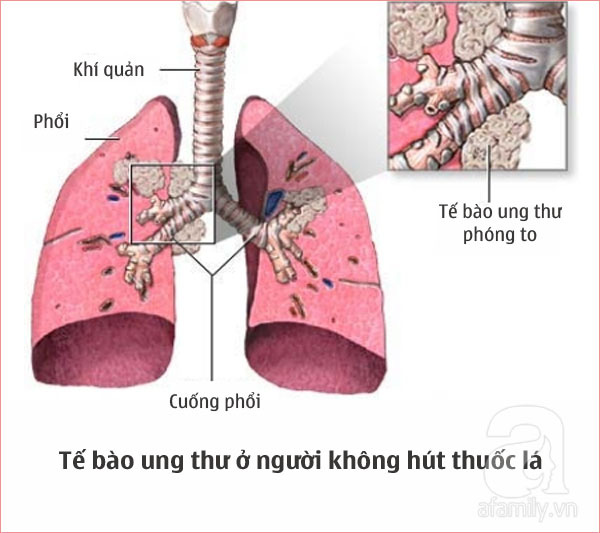 ung-thu-phoi-1