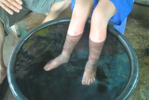Cho con ngâm chân trong nước lá 2 lần, chị Hải vô cùng vui mừng khi thấy bao nhiêu mủ đều được kéo hết ra và vết mụn cũng khỏi nhanh chóng sau vài ngày