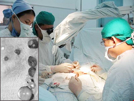 Các bác sĩ  BV Bình Dân phẫu thuật cho bệnh nhân gặp biến chứng do bơm silicon. Ảnh: Hải Âu