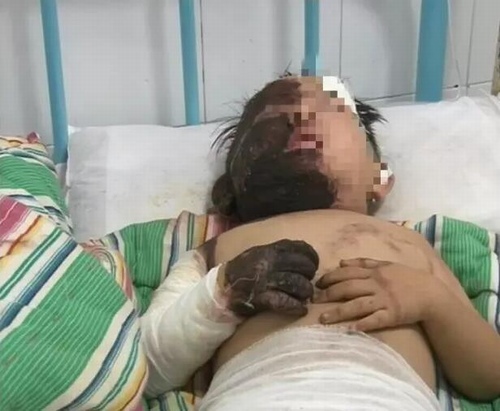 Cậu bé 3 tuổi ở Hà Nam, Trung Quốc bị bỏng nặng nửa người do ngã vào chảo dầu đang sôi