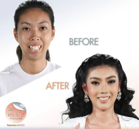 Khuôn mặt trước và sau khi phẫu thuật 
