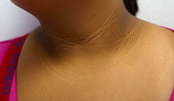acanthosis-nigricans_342x198_c5he23