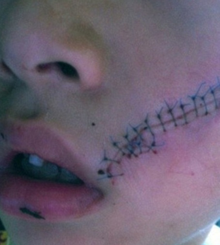 Gương mặt của cậu bé bị mảnh vỡ lon nước cắt vào mặt