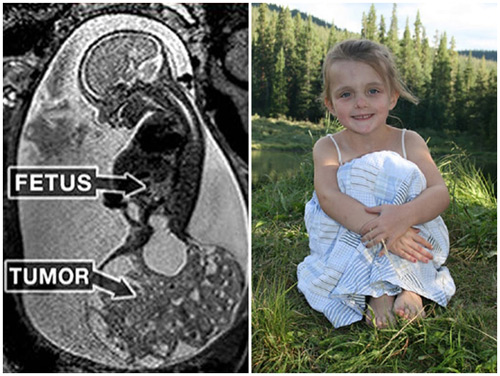 Hình ảnh siêu âm bé Macie Hope McCartney và khối u dưới phần xương cụt (bên trái) và ảnh hiện tại của bé.