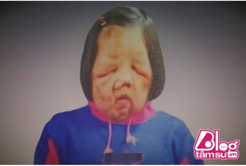 Lúc mới được sinh ra, Hyun Hee vẫn là một đứa trẻ khỏe mạnh bình thường nhưng đến năm 2 tuổi bắt đầu xuất hiện triệu chứng U sợi thần kinh. 