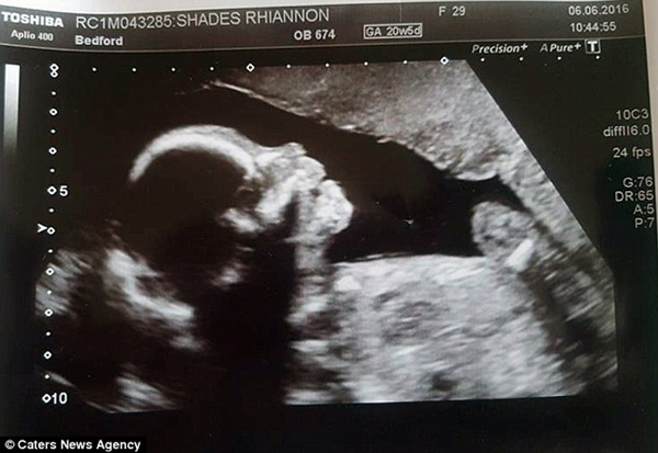 Mọi thứ vẫn suôn sẻ khi Rhiannon Shades mang thai con gái nhỏ ở tuần thứ 20.