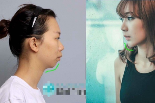 Hình ảnh trước và sau phẫu thuật thẩm mỹ của Tuyết Nhung.