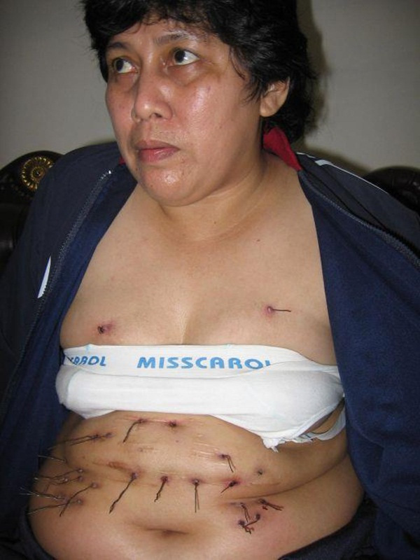 Những dây kim loại đâm xuyên qua bụng và ngực khiến cô phải chịu đựng nhiều đau đớn.
