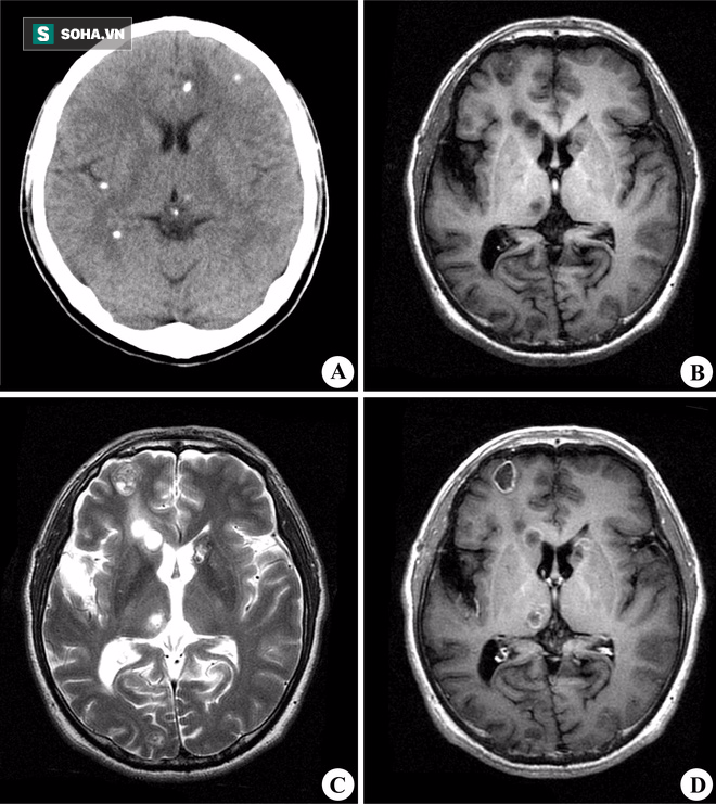 Ảnh chụp não có ký sinh trùng.