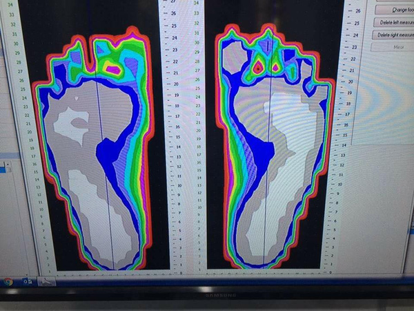 Hình ảnh scan bàn chân của bố Tuva bình thường,