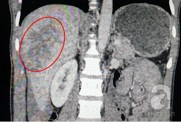 Ảnh chụp CT cho thấy phần gan anh T. bị vỡ. (Ảnh: Bệnh viện cung cấp)