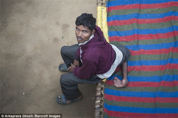 Đôi chân thừa vướng víu khiến việc đi lại cũng như nghỉ ngơi của anh chàng vô cùng khó khăn, càng khiến anh thêm tủi thân, tuyệt vọng vì sự bất bình thường của mình.  Arun Kumar, 22 tuổi iện đang sống tại Uttar Pradesh, Ấn Độ không giống như những đứa trẻ bình thường, ngay từ khi sinh ra Arun đã có tới 4 chân. Ngoài hai chân như bình thường, Arun còn mọc thêm hai chân lủng lẳng trên lưng. Ngay khi được sinh ra, nhìn thấy hình dạng khác thường của con mình, gia đình anh đã ngay lập tức đưa anh đến bệnh viện Farrukhabad, tuy nhiên sau khi tiến hành thăm khám các bác sĩ kết luận hai chân thừa của Arun không thể cắt bỏ bởi khi đó anh còn rất nhỏ sẽ nguy hiểm đến tính mạng và nguy cơ thất bại rất cao. Suốt 5 năm đầu, cha mẹ Arun đã bế anh đi khắp nơi tìm cách chữa trị nhưng đều chỉ nhận được cái lắc đầu của bác sĩ. Càng trưởng thành đôi chân càng là gánh nặng của Arun, vì cuộc sống quá bế tắc, mới đây anh chàng đã quyết định lên mạng xã hội tìm kiếm sự giúp đỡ. Rất may cho Arun, một bác sĩ có tên Hermant Sharmant đã tiến hành khám và nghiên cứu điều trị cho anh chàng. Hiện tại Arun rất hi vọng mình sẽ sớm được cắt bỏ chân thừa. 