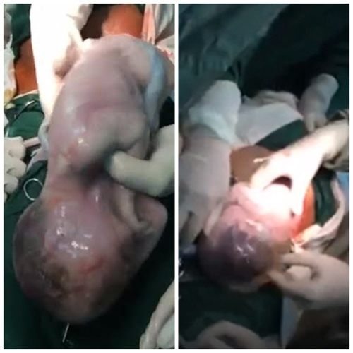 Hình ảnh các bé nằm trong bọc ối khi chào đời được ghi lại bởi chính các bác sĩ trong ekip đỡ đẻ.