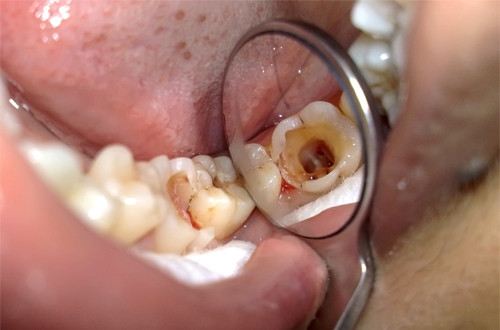 Tủy răng bị viêm thủng nghiêm trọng.
