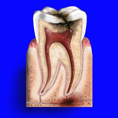 Phần màu đỏ chính là tủy răng. Vi khuẩn gây sâu răng đang lan xuống tủy răng.