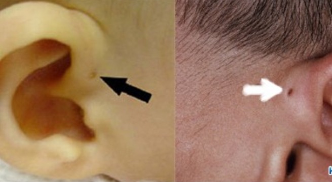  Thấy vành tai có lỗ nhỏ như đầu kim, mẹ cẩn trọng rò luân nhĩ ở trẻ