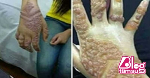 Chỉ là nghiện xăm hình henna thôi mà cô gái trẻ này cũng phải nhận kết cục không thể đau đớn hơn. 
