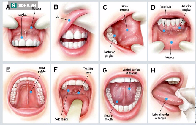 Các vị trí loét ở miệng có thể là dấu hiệu của mầm ung thư (Ảnh minh họa)