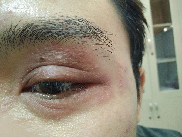 Tổn thương vùng mắt ở bệnh nhân bị kiến ba khoang đốt.