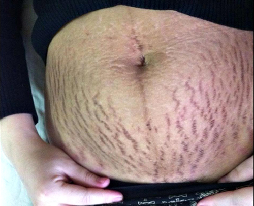 Cận cảnh vùng da bị rạn khi mang thai khiến nhiều người kinh hoàng 