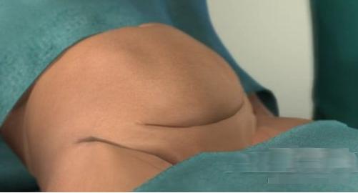 Sau khi thai phụ đã được gây tê, thử phản ứng, bác sĩ sẽ rạch một đường chừng hơn 10cm trên da rồi đến các lớp mô và chạm tới tử cung.