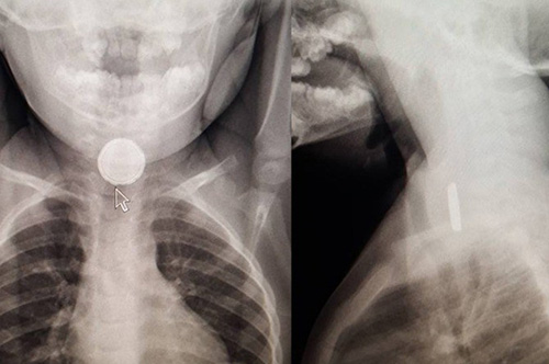 Hình ảnh X-quang viên pin tròn mắc kẹt trong thực quản (Ảnh: CTV News)