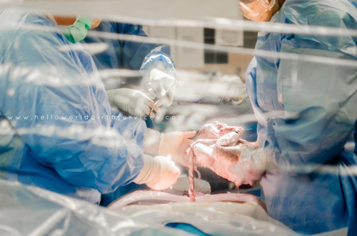 Hình ảnh em bé vừa chào đời bằng phương pháp sinh mổ còn nguyên dây rốn gắn với nhau thai trong cơ thể mẹ. 