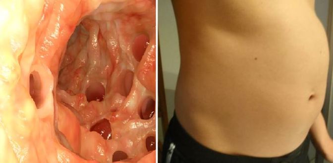Do-You-Have-Bloated-Stomach-Warning-Signs-You-Should-Never-Ignore